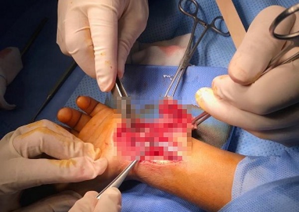 فريق طبي بمستشفى الأمير عبدالمحسن بالعلا ينجح في إنقاذ (يد) طفل جراء إصابة بالغه