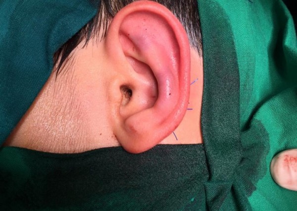 في عملية نادرة من نوعها: فريق طبي بمستشفى الأمير عبدالمحسن بالعلا ينجح في إجراء عملية تجميل بروز الأذن لطفل