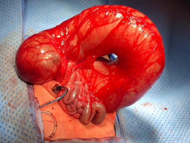 فريق طبي بولادة المدينة ينقذ رضيعه بعمليتين نادرة من نوعها على مستوى المنطقة فريق طبي بولادة المدينة ينقذ رضيعه بعمليتين نادرة من نوعها على مستوى المنطقة