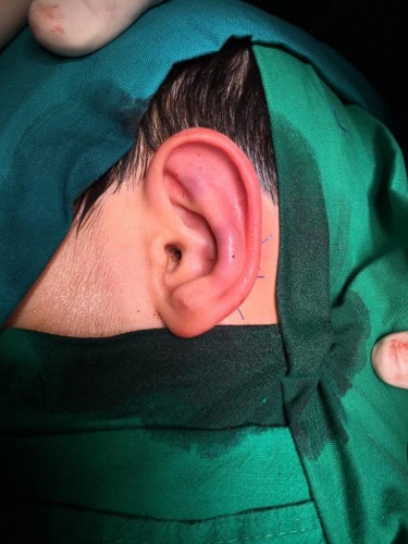 في عملية نادرة من نوعها: فريق طبي بمستشفى الأمير عبدالمحسن بالعلا ينجح في إجراء عملية تجميل بروز الأذن لطفل